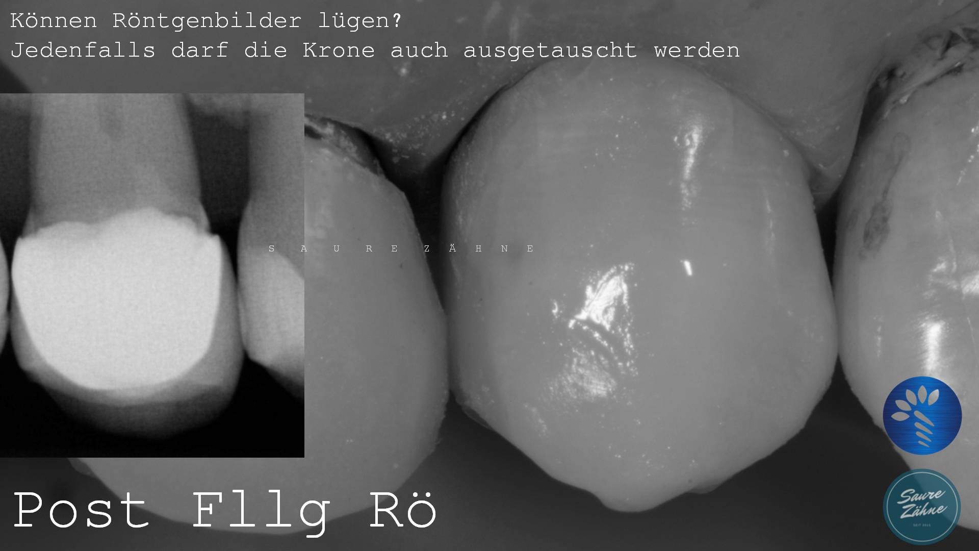 Lateral - Direkte Komposit Nur Von Der Bukkalen Ansicht